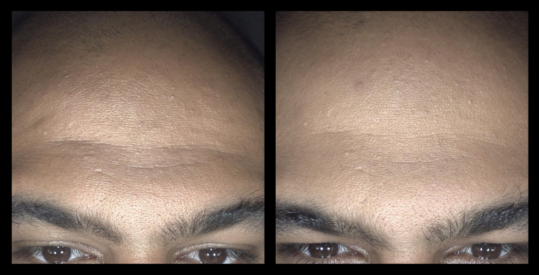 Before and after results from 633nm red and 830nm light therapy using MediLUX LED machine. Significant softening of forehead lines and fine wrinkles, with smoother texture, enhanced skin tone, and a more youthful appearance.