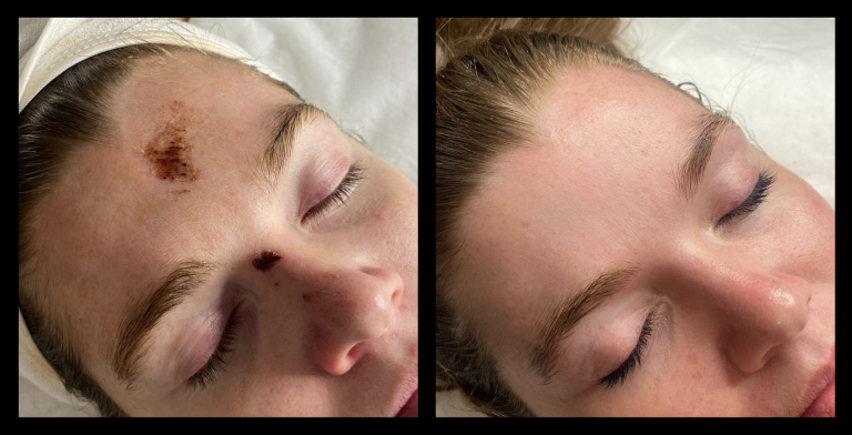 Before and after results from red (633nm) and near-infrared (830nm) LED light therapy using MediLUX LED machine, showing accelerated healing of a forehead injury. Skin appears fully recovered with no scarring or visible signs of prior trauma.