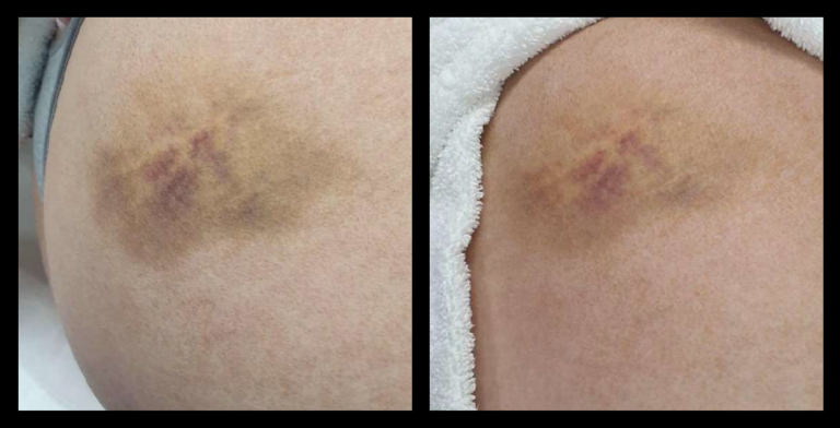 Before and after results from 590nm yellow LED light therapy using MediLUX LED machine, showing visible improvement in bruising after just one treatment. Reduced discolouration and a calmer skin tone in the treated area.