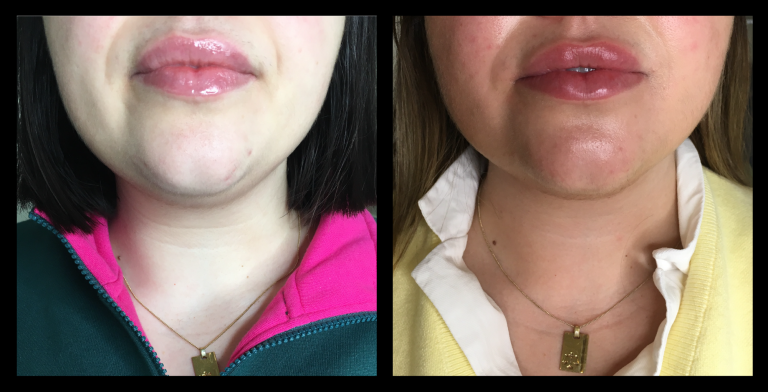 Before and after results from LUX Series RF skin tightening on the lower face and jawline. Treatment available on UltraLUX, UltraLUX PRO, and SlimLUX devices. Visible lifting, contouring, and firming beneath the chin with improved definition around the jawline.