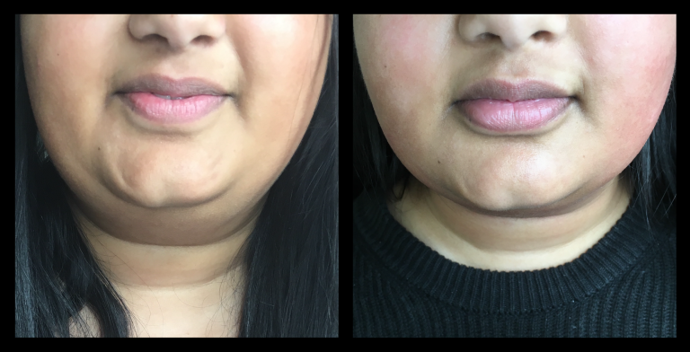 Before and after results from LUX Series RF skin tightening on the lower face and jawline. Treatment available on UltraLUX, UltraLUX PRO, and SlimLUX devices. Visible lifting, contouring, and firming beneath the chin with improved definition around the jawline.