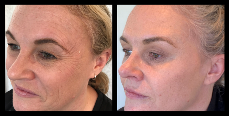 Before and after results from LUX Series RF skin tightening on the face, in conjunction with skin needling. Treatment available on UltraLUX, UltraLUX PRO, and SlimLUX devices. Visible reduction in fine lines and wrinkles around the eyes and cheeks, with smoother, firmer skin texture following treatment.
