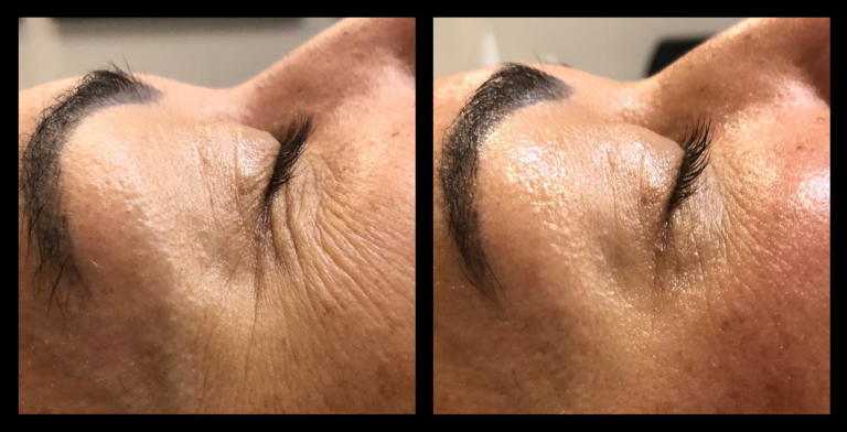 Before and after results from LUX Series RF skin tightening around the eyes. Treatment available on UltraLUX, UltraLUX PRO, and SlimLUX devices. Significant reduction in fine lines and crepiness, with smoother, firmer skin texture on the upper cheek and under-eye area.