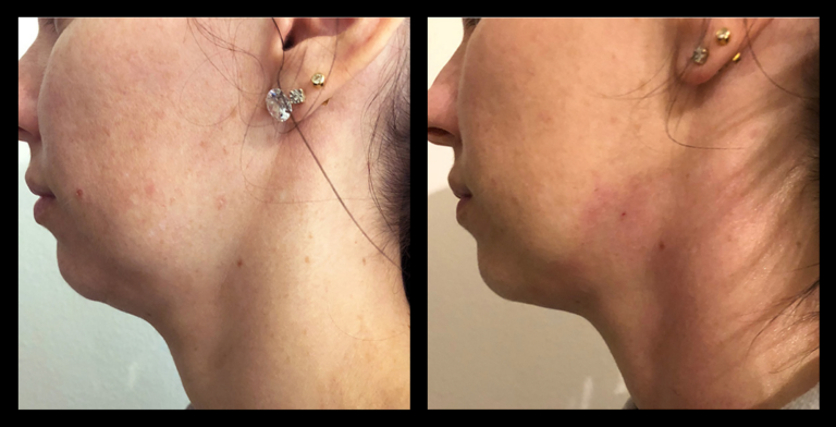 Before and after results from LUX Series RF skin tightening on the chin and neck area. Treatment available on UltraLUX, UltraLUX PRO, and SlimLUX devices. Noticeable improvement in jawline definition, skin laxity, and firmness beneath the chin following non-invasive treatment.