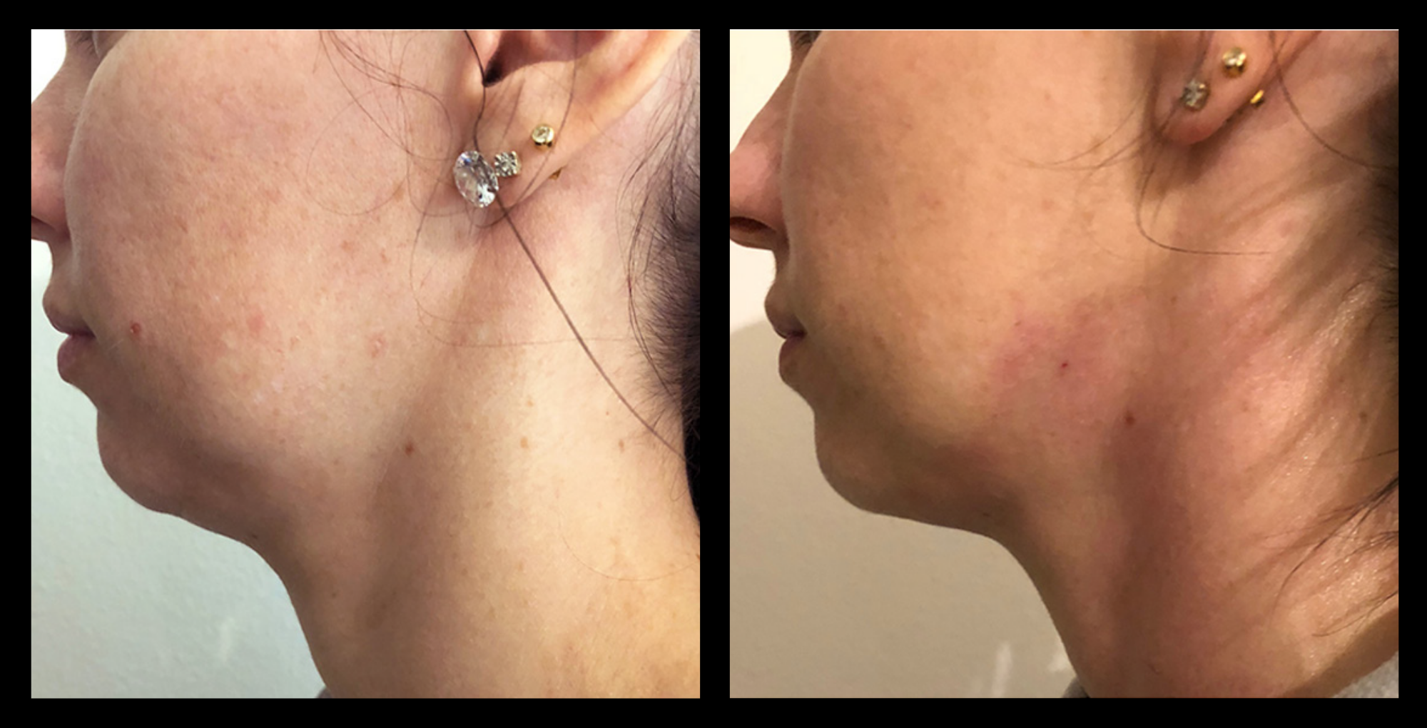 Before and after results from LUX Series RF skin tightening on the chin and neck area. Treatment available on UltraLUX, UltraLUX PRO, and SlimLUX devices. Noticeable improvement in jawline definition, skin laxity, and firmness beneath the chin following non-invasive treatment.