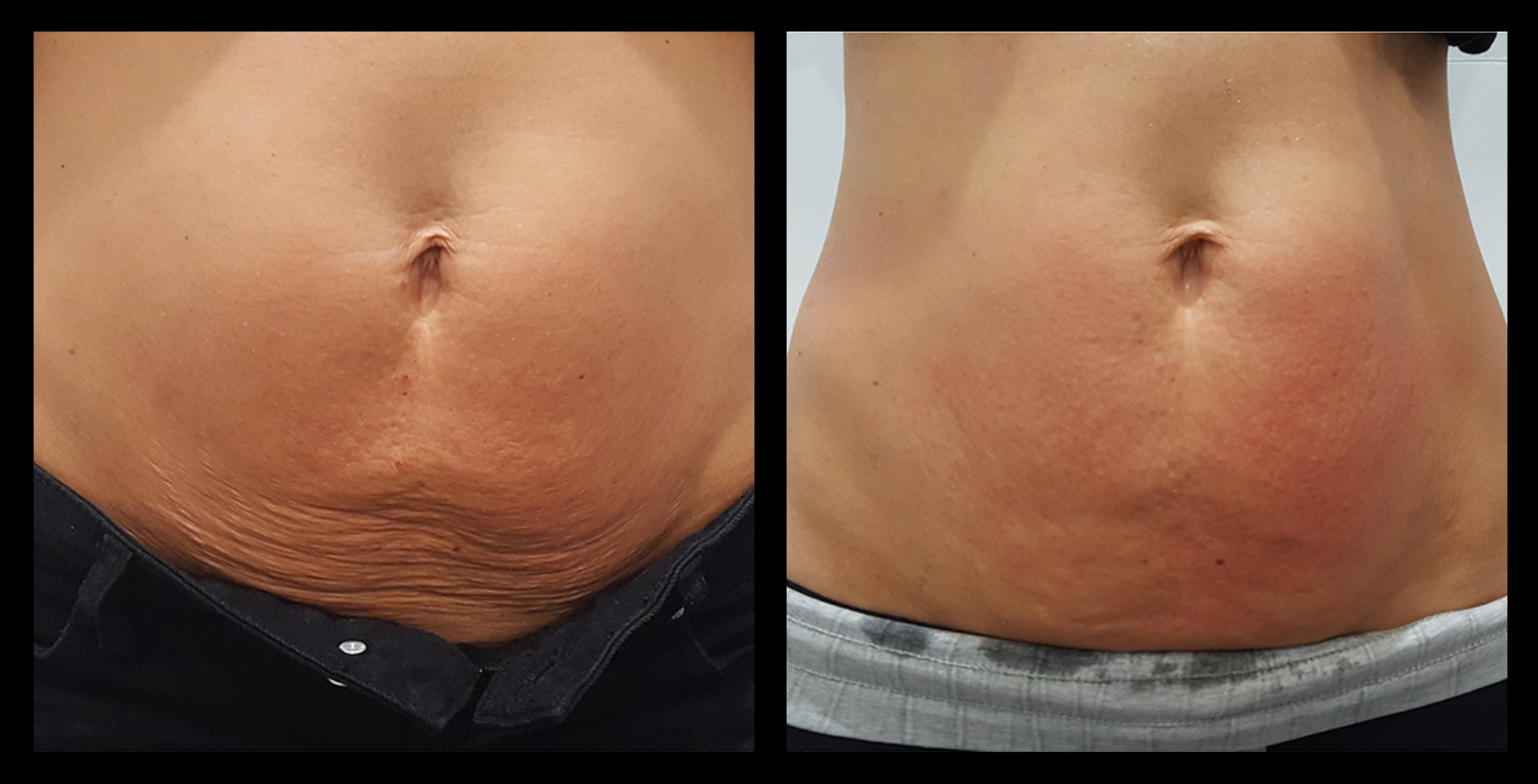 Before and after results from LUX Series RF skin tightening on the abdomen. Treatment available on UltraLUX, UltraLUX PRO, and SlimLUX devices. Visible tightening, firming, and smoothing with improved skin laxity and abdominal firmness.