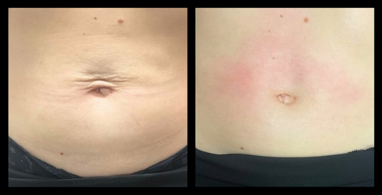Before and after with LUX Series RF Skin Tightening used in UltraLUX PRO on post-pregnancy abdomen. Visible reduction in skin laxity and improved firmness.