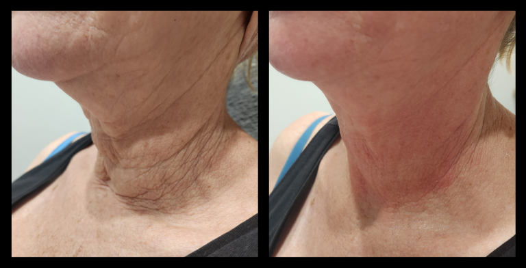 Before and after results from LUX Series RF skin tightening on the neck. Treatment available on UltraLUX, UltraLUX PRO, and SlimLUX devices. Dramatic improvement in skin laxity, with visible tightening, smoothing, and a noticeably firmer, more youthful neck contour.