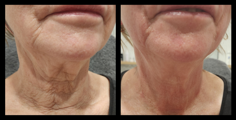 Before and after results from LUX Series RF skin tightening on the neck. Treatment available on UltraLUX, UltraLUX PRO, and SlimLUX devices. Dramatic improvement in skin laxity, with visible tightening, smoothing, and a noticeably firmer, more youthful neck contour.