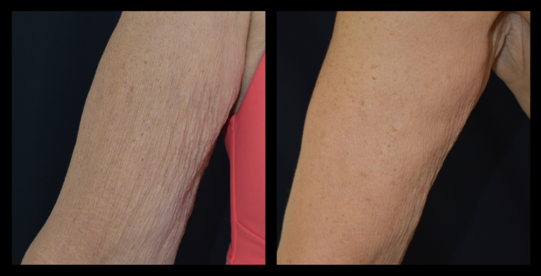 Before and after results from LUX Series RF skin tightening on the upper arms. Treatment available on UltraLUX, UltraLUX PRO, and SlimLUX devices. Visible tightening, firming, and smoothing with improved tone and reduced laxity in the upper arm area.