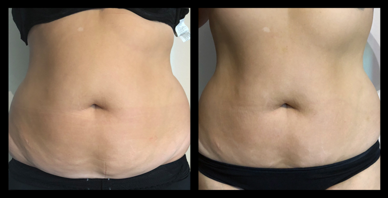 Before and after results from LUX Series ultrasound body contouring on the abdomen. Treatment available on UltraLUX, UltraLUX PRO, and SlimLUX devices. Visible reduction in abdominal circumference and a noticeably more sculpted, toned appearance.