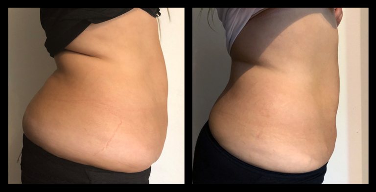Before and after results from LUX Series ultrasound body contouring on the side of the abdomen and bra line area. Treatment available on UltraLUX, UltraLUX PRO, and SlimLUX devices. Visible reduction in abdominal circumference, smoother contour, and reduced lumpiness, with a noticeable reduction in the appearance of the thickness of skin folds around the bra line for a more sculpted, toned silhouette.