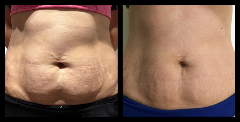 Before and after results from LUX Series ultrasound body contouring on the abdomen. Treatment available on UltraLUX, UltraLUX PRO, and SlimLUX devices. Visible reduction in abdominal circumference and a noticeably more sculpted, toned appearance.