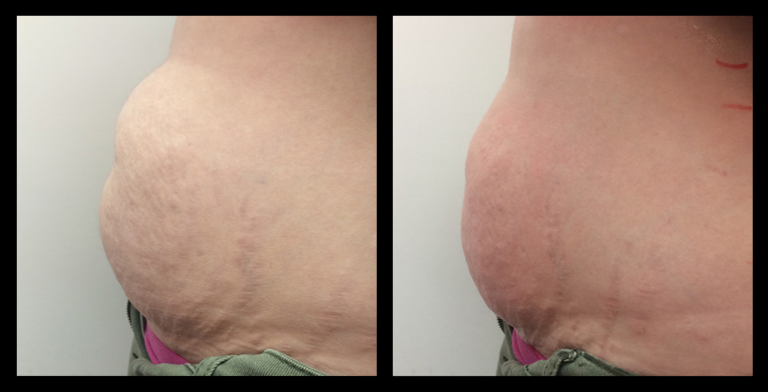 Before and after results from LUX Series ultrasound body contouring on the side of the abdomen. Treatment available on UltraLUX, UltraLUX PRO, and SlimLUX devices. Visible reduction in abdominal circumference, smoother contour, and reduced lumpiness for a more sculpted, toned silhouette.