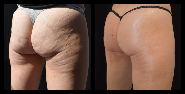 Before and after results from LUX Series body contouring on the buttocks. Treatment available on UltraLUX, UltraLUX PRO, and SlimLUX devices. Visible lifting and firming of the buttocks with a noticeable reduction in the appearance of skin laxity for a smoother, more toned result.