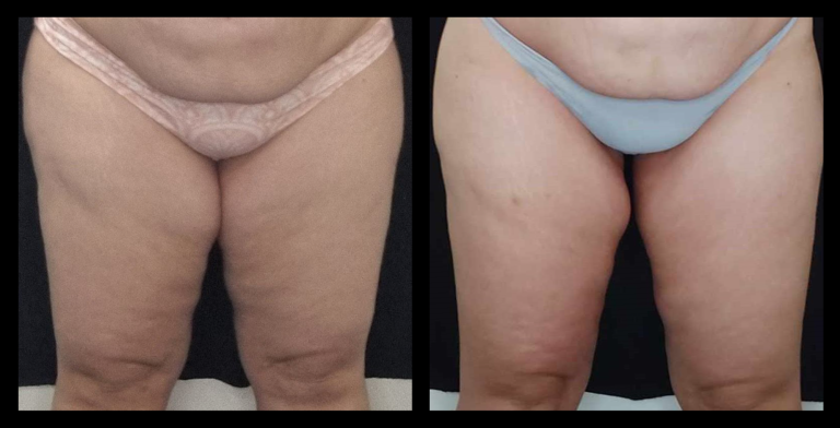Before and after results from LUX Series body contouring on the thighs. Treatment available on UltraLUX, UltraLUX PRO, and SlimLUX devices. Visible reduction in dimpling and lumpiness, with smoother skin texture, improved tone, and enhanced overall contour across the thigh area.