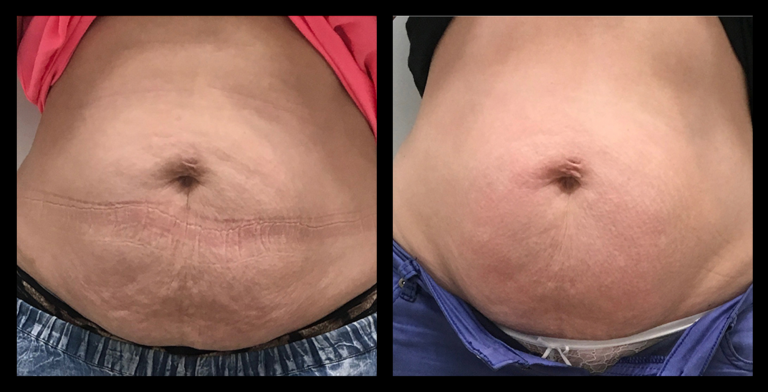 Before and after results from LUX Series body contouring on the abdomen. Treatment available on UltraLUX, UltraLUX PRO, and SlimLUX devices. Visible reduction in abdominal lumpiness with a smoother contour and more refined, toned appearance.