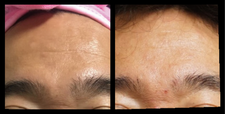 Fractional RF Skin Resurfacing. After 1 Treatment. Photo Courtesy of Asterasys.