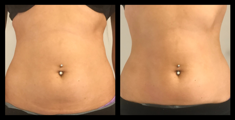Before and after results from LUX Series body contouring on the abdomen. Treatment available on UltraLUX, UltraLUX PRO, and SlimLUX devices. Visible skin tightening with enhanced abdominal contour, shape, and definition for a more refined and sculpted appearance.