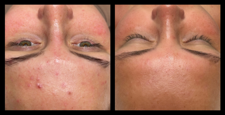 Before and after results of Carbon Facial, Hydrodermabrasion, and LED Light Therapy after 4 treatments at Exquise Skin Boutique, Harrington Park, NSW. Noticeable improvements in skin clarity, brightness, and texture—ideal for acne-prone, congested, or dull skin. A top skin rejuvenation solution combining exfoliation, detoxification, and LED light therapy benefits.