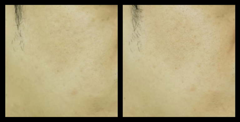 Fractional RF skin resurfacing machine before and after results after 1 treatment showing improved skin texture and reduced fine lines. Courtesy of Asterasys.
