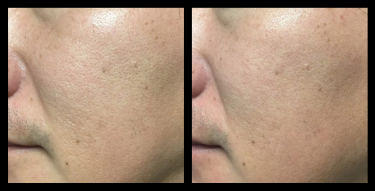 Fractional RF skin resurfacing before and after photo after 1 treatment showing smoother skin texture and reduced pigmentation. Courtesy of Asterasys.