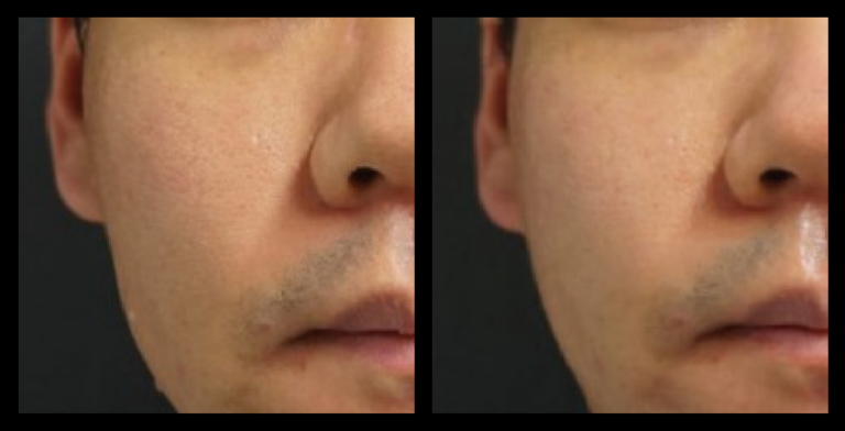 Before and after results of Fractional RF machine Skin Resurfacing after 1 treatment, showing improved skin tone, texture, and reduced fine lines. Photo courtesy of Asterasys.