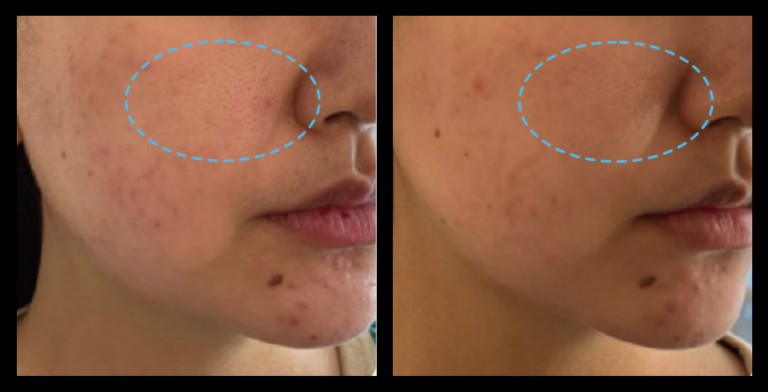 Fractional RF Skin Resurfacing before and after 1 treatment—visible improvement in skin texture, tone, and reduction of fine lines. Photo courtesy of Asterasys.