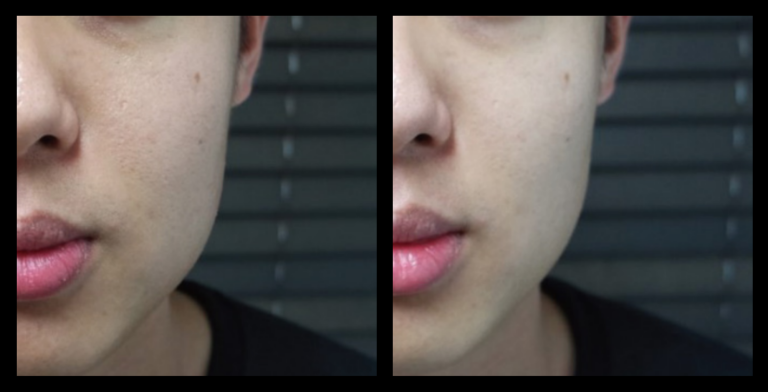 Fractional RF Skin Resurfacing before and after 1 treatment—visible improvement in skin texture, tone, and reduction of fine lines. Photo courtesy of Asterasys.