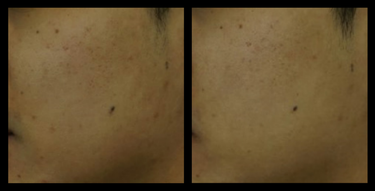 Before and after 1 treatment with Fractional RF Skin Resurfacing—smoother skin texture, reduced fine lines, and rejuvenated complexion. Photo courtesy of Asterasys.