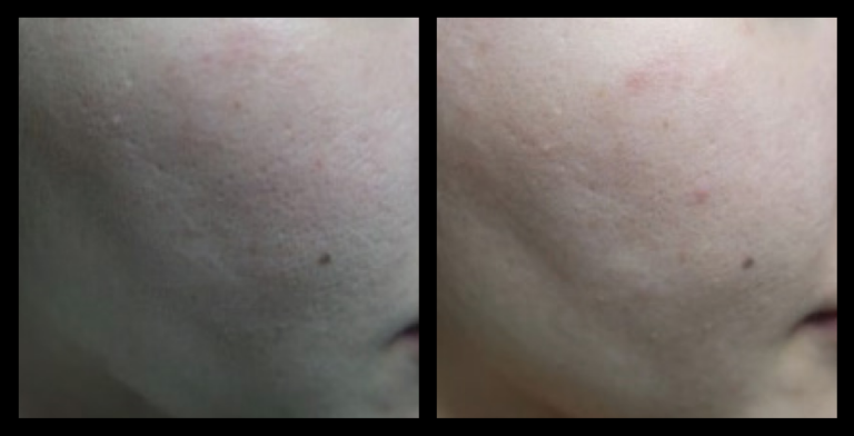 Fractional RF Skin Resurfacing before and after 1 treatment—visible improvement in skin tone, texture, and fine lines. Effective non-invasive facial rejuvenation. Photo courtesy of Asterasys.