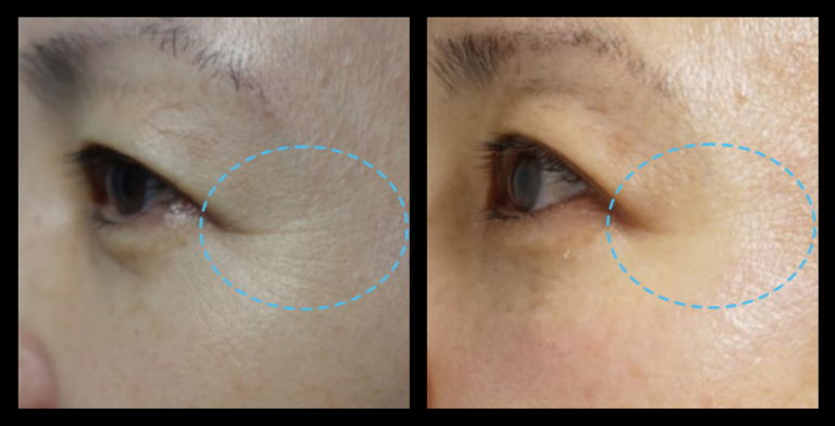 Before and after 1 treatment with Fractional RF Skin Resurfacing—improved skin clarity, reduced texture and pigmentation. Non-surgical facial rejuvenation results. Photo courtesy of Asterasys.