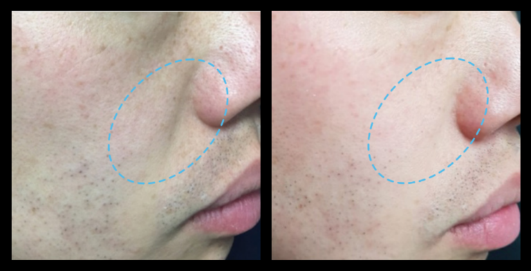 Before and after 1 treatment of Fractional RF machine Skin Resurfacing showing reduced fine lines, improved skin texture, and rejuvenated appearance. Non-surgical skin resurfacing results. Photo courtesy of Asterasys.