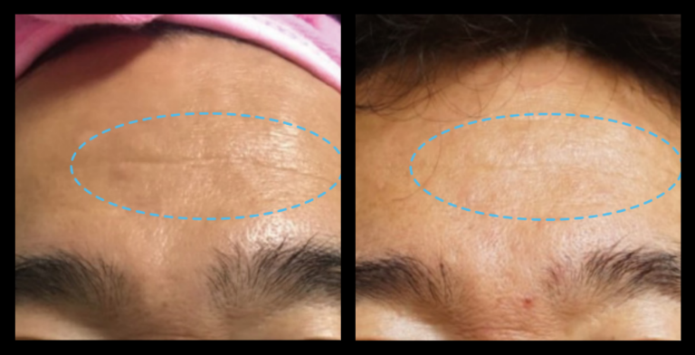Fractional RF Skin Resurfacing machine before and after 1 treatment showing visible improvement in skin tone, reduced texture irregularities, and overall rejuvenation. Non-invasive facial resurfacing results. Photo courtesy of Asterasys.