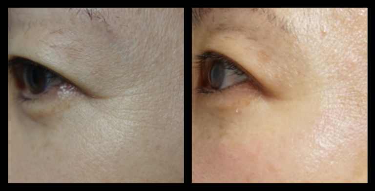 Fractional RF Skin Resurfacing before and after 1 treatment showing smoother skin texture, reduced fine lines, and improved skin clarity. Effective non-surgical skin rejuvenation results. Photo courtesy of Asterasys.