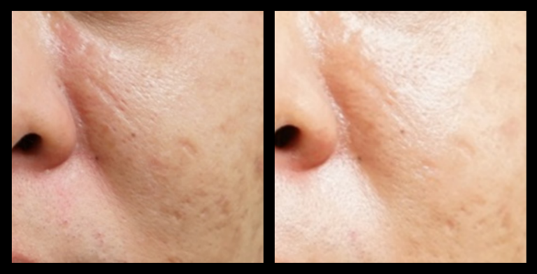 Fractional RF Skin Resurfacing before and after 1 treatment showing smoother skin texture, reduced fine lines, and improved skin clarity. Effective non-surgical skin rejuvenation results. Photo courtesy of Asterasys.
