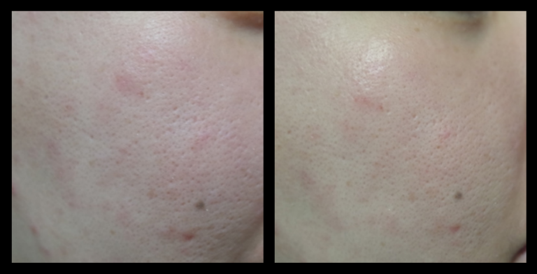 Fractional RF Skin Resurfacing device before and after 1 treatment showing visible improvement in skin tone, reduced texture irregularities, and overall rejuvenation. Non-invasive facial resurfacing results. Photo courtesy of Asterasys.