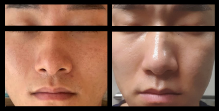 Before and after 1 treatment of Fractional RF Skin Resurfacing showing reduced fine lines, improved skin texture, and rejuvenated appearance. Non-surgical skin resurfacing results. Photo courtesy of Asterasys.