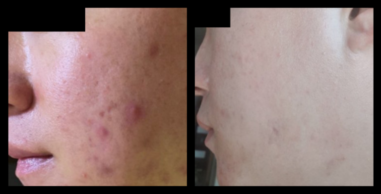 Fractional RF Skin Resurfacing device before and after 1 treatment—visible improvement in skin tone, texture, and fine lines. Non-invasive facial rejuvenation results. Photo courtesy of Asterasys.
