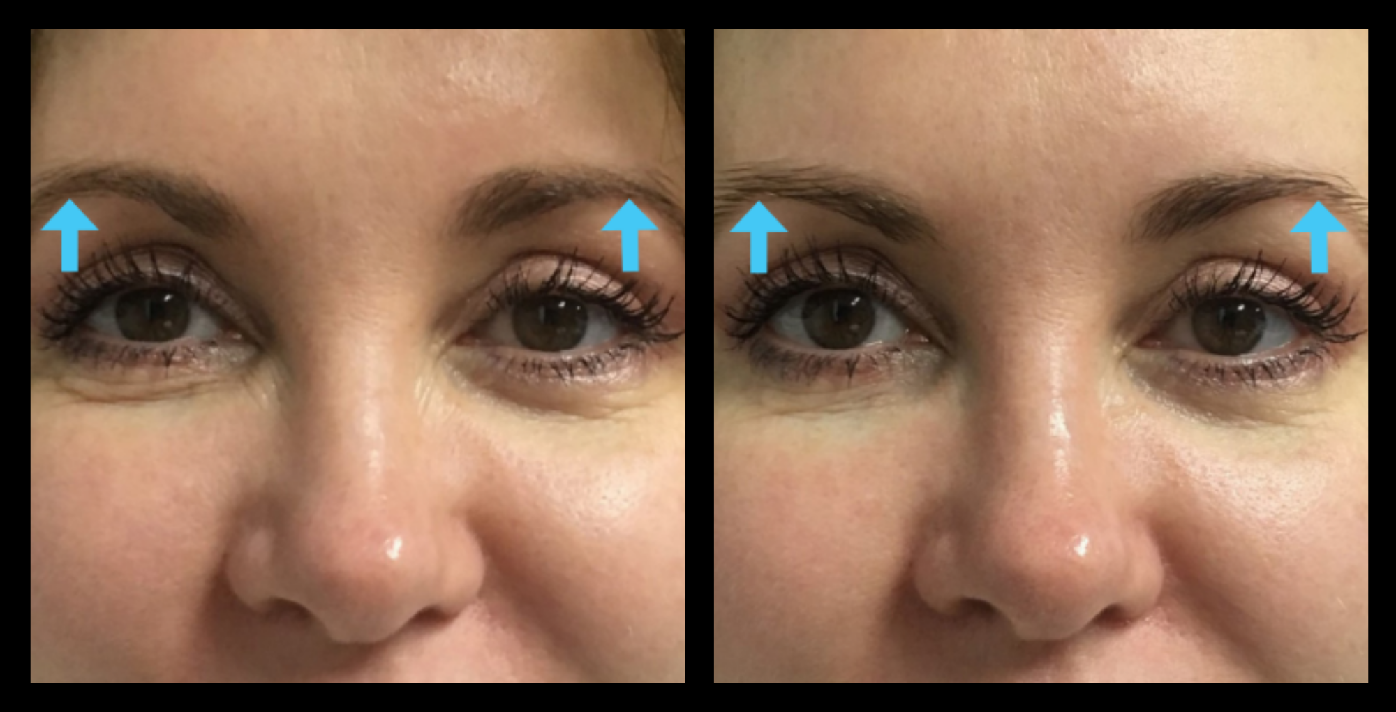 Before and after HIFU machine non-surgical face lift results after 1 treatment, showing visible facial skin tightening and improved jawline definition. Photo courtesy of Asterasys. HIFU face lift for non-surgical anti-aging, collagen stimulation, and contour enhancement.