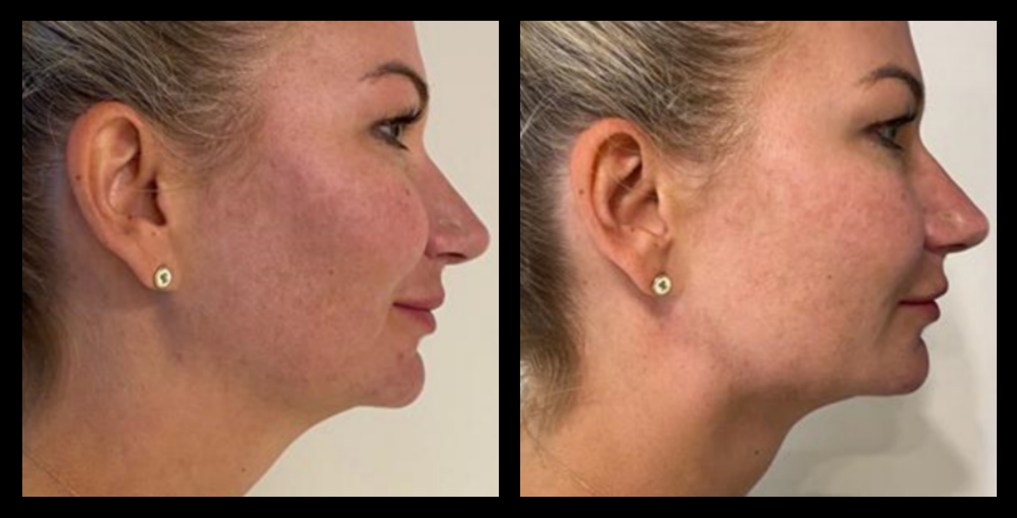 Before and after HIFU non-surgical face lift results after 1 treatment, revealing tighter skin, smoother texture, and enhanced facial contours. Photo courtesy of Asterasys. Non-invasive HIFU facial treatment for lifting, skin firming, and visible anti-aging effects.