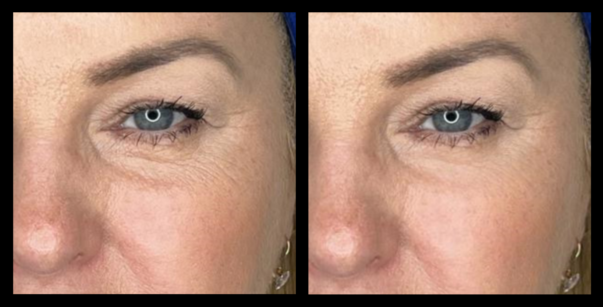 HIFU non-surgical face lift before and after results after 2 treatments – visible skin tightening and wrinkle reduction. Photo courtesy of Asterasys.