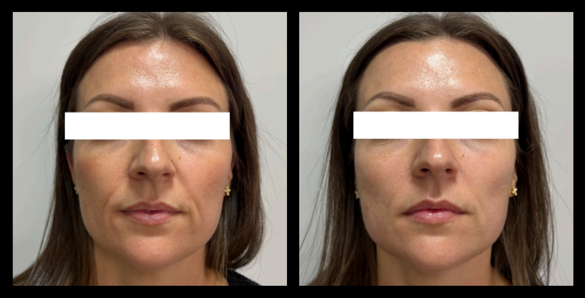 HIFU non-surgical face lift before and after image showing visible skin tightening and lifting after 1 treatment. Photo courtesy of Loyal Beauty and Grooming, Scarborough, WA.