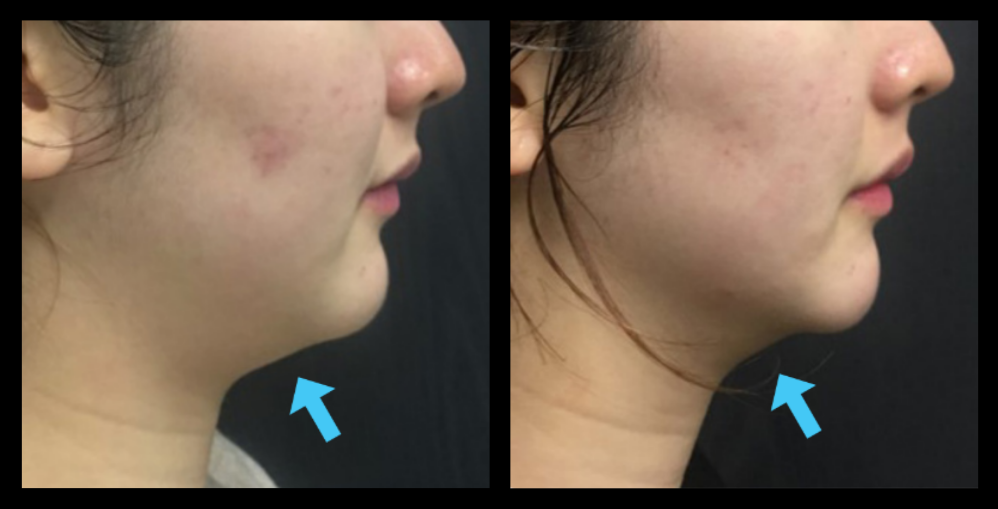 Before and after HIFU non-surgical neck lift results after 1 treatment, showing visible skin tightening and lifted neck contour. Photo courtesy of Asterasys. High-Intensity Focused Ultrasound for non-invasive neck rejuvenation and anti-aging results.