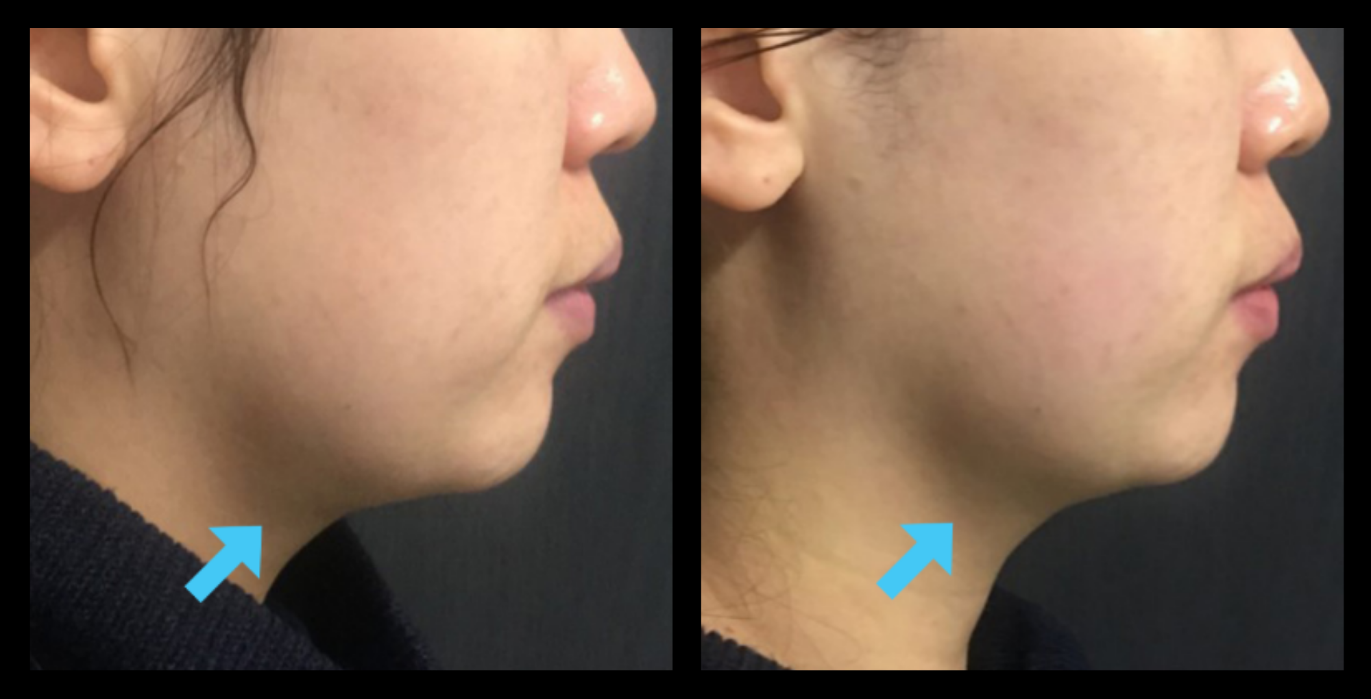 Before and after HIFU non-surgical neck lift results after 1 treatment, highlighting firmer skin and improved jawline definition. Photo courtesy of Asterasys. Non-invasive HIFU treatment for neck tightening and youthful skin appearance.