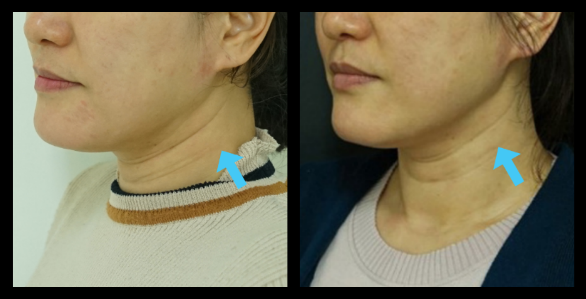 Before and after HIFU non-surgical neck lift results after 1 treatment, demonstrating visible skin tightening and reduction in neck lines. Photo courtesy of Asterasys. Non-invasive HIFU treatment for neck firming and youthful contour enhancement.