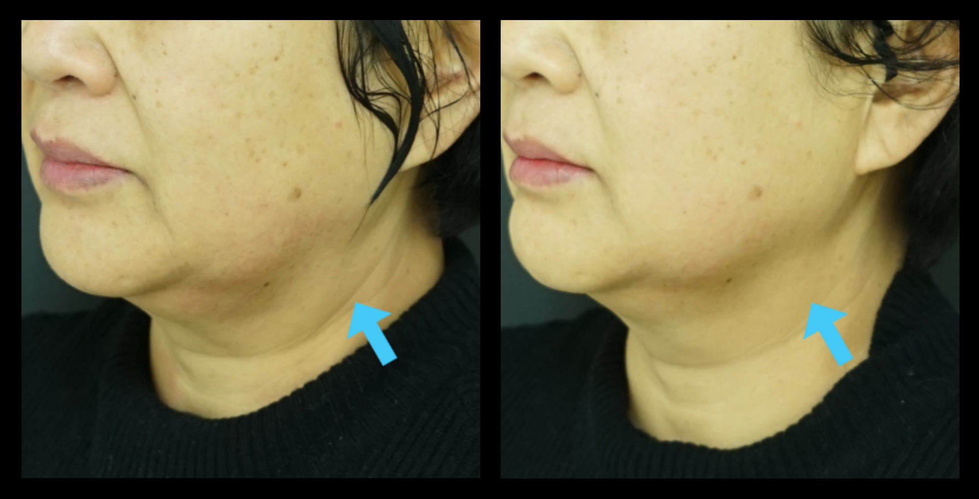 Before and after HIFU machine non-surgical neck lift results after 1 treatment, showing enhanced skin elasticity and smoother neck profile. Photo courtesy of Asterasys. HIFU neck lift for non-invasive skin tightening and anti-aging treatment.