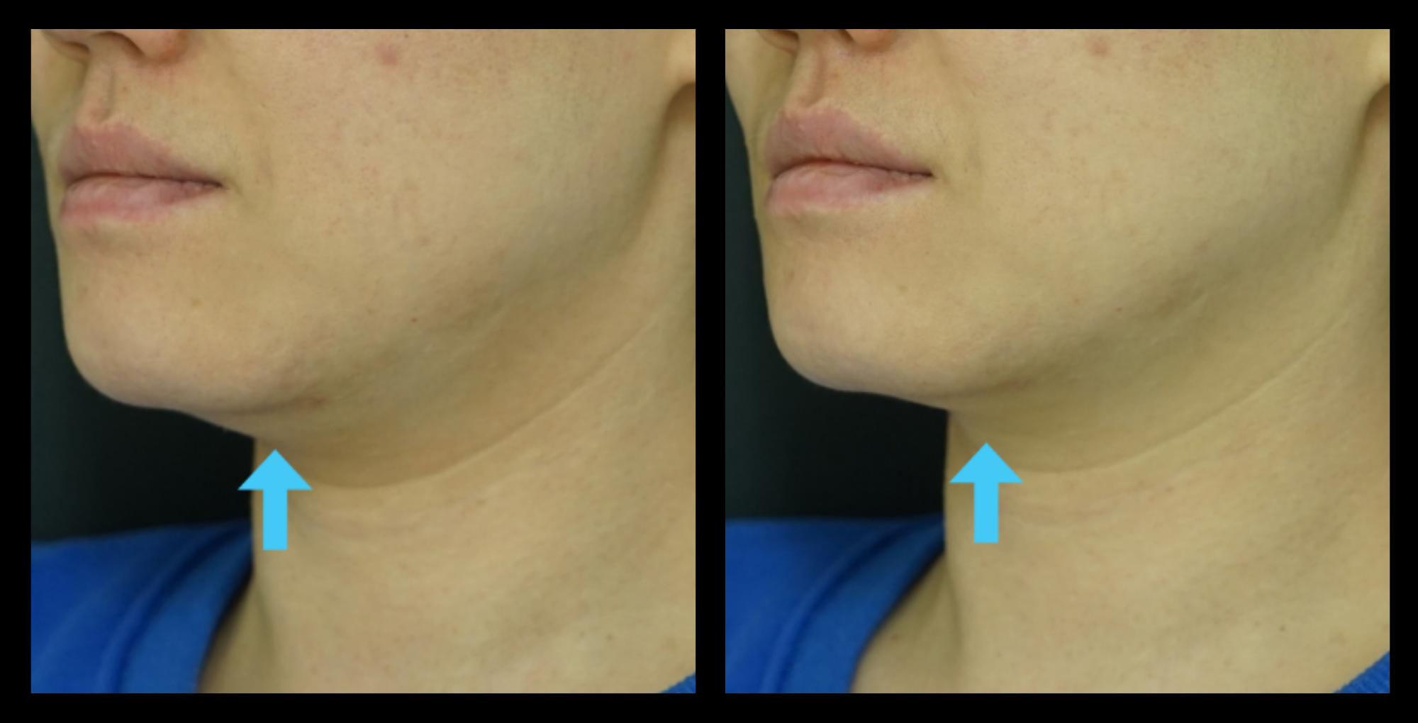 Before and after HIFU machine non-surgical neck lift results after 1 treatment, showing enhanced skin elasticity and smoother neck profile. Photo courtesy of Asterasys. HIFU neck lift for non-invasive skin tightening and anti-aging treatment.