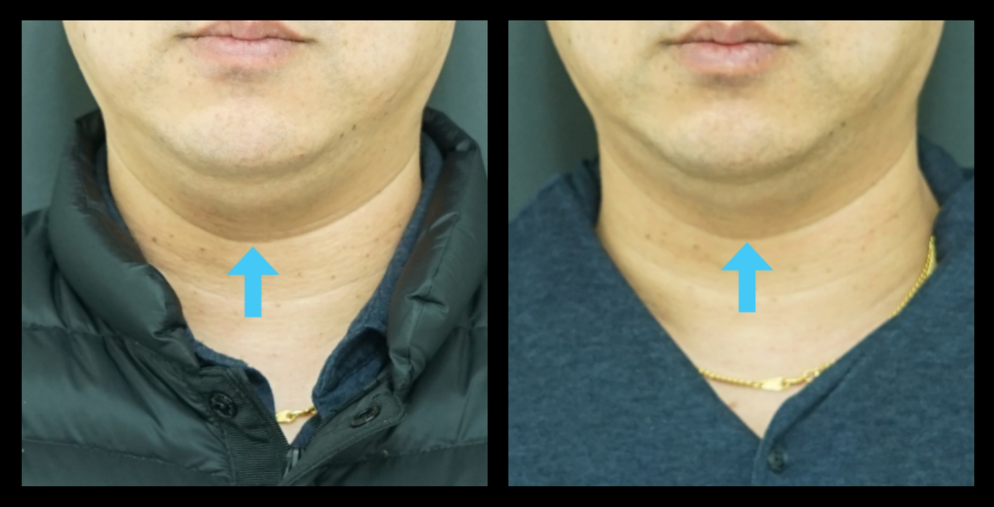 Before and after HIFU non-surgical neck lift results after 1 treatment, highlighting tighter skin and improved neck contour. Photo courtesy of Asterasys. HIFU technology for non-invasive neck rejuvenation and visible anti-aging effects.