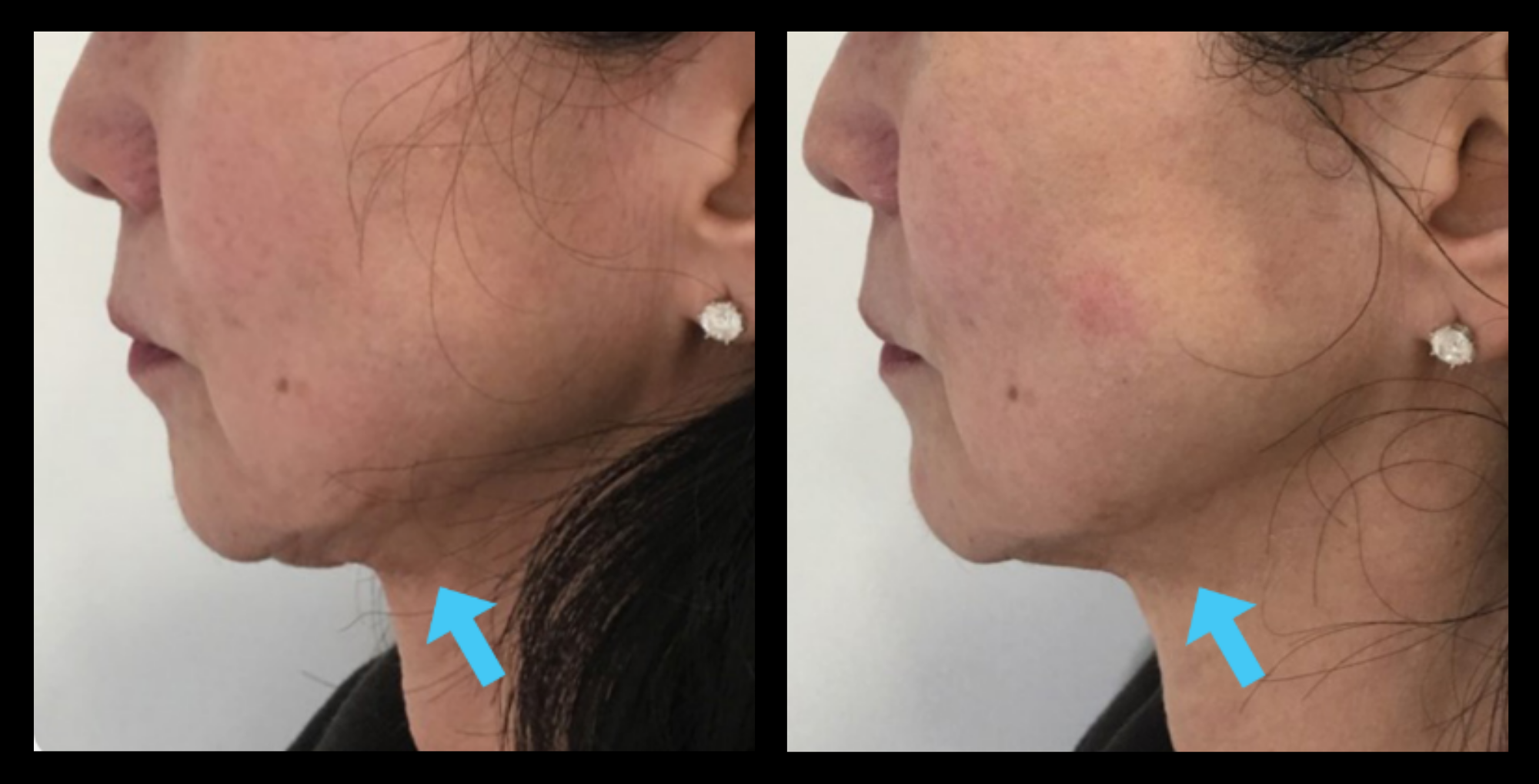 Before and after HIFU machine non-surgical neck lift results after 1 treatment, revealing smoother, tighter skin and reduced neck laxity. Photo courtesy of Asterasys. High-Intensity Focused Ultrasound for non-invasive neck lift and visible anti-aging skin tightening.